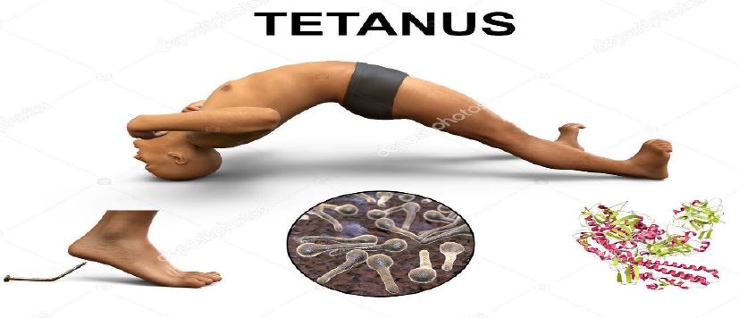 tetanus