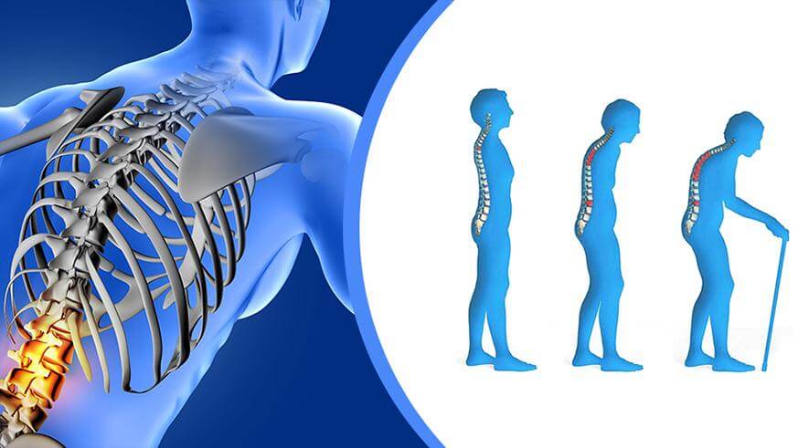 osteoporosis_1